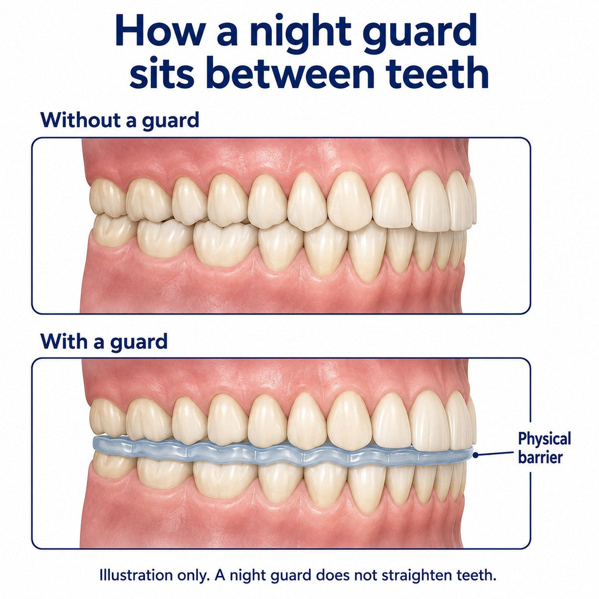 Educational comparison explaining tooth contact with and without a protective night guard