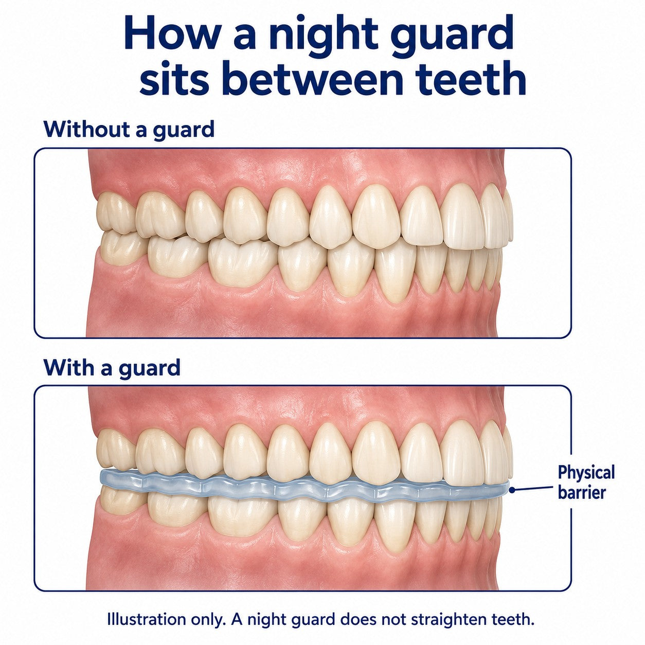 Educational comparison explaining tooth contact with and without a protective night guard